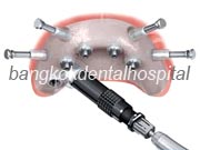 Branemark system Zygoma with NobelGuide Bangkok