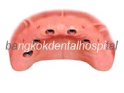 Branemark system Zygoma with NobelGuide Thailand