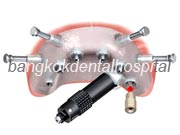 Branemark system Zygoma with NobelGuide Thailand