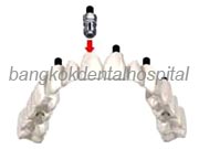 Branemark system Zygoma with NobelGuide Thailand