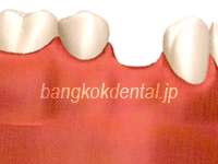 インプラント, バンコクの日本人歯科医