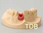 straumann anatomic abutment lab procedure