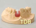 straumann anatomic abutment chairside procedure