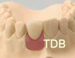 straumann anatomic abutment chairside procedure