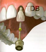 Straumann CADCAM screw retained crown