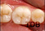 IPS e.max crown step by step