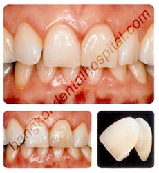 IPS Empress Esthetic Veneers