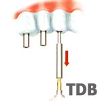 Immediate implant Function - Multiple Restorations in dental bangkok
