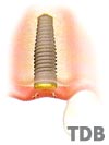 conventional implant