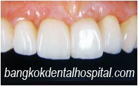 after dental extreme makeover : dental implants