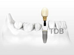 NobelReplace Tapered implant