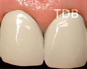 before lava all ceramic restorations