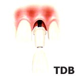 Nobel Speepy Groovy with Procera Abutment & Procera Crown