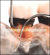 Periodontics bangkok, periodontics thailand