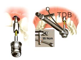 procera procera implant abutment connection