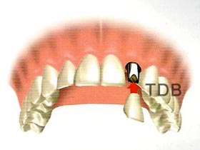 NobeProcera Iimplant Abutment