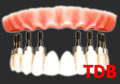 Teeth-in-an-Hour,NobelReplace implants Groovy+Titanium framework+porcelain bridges